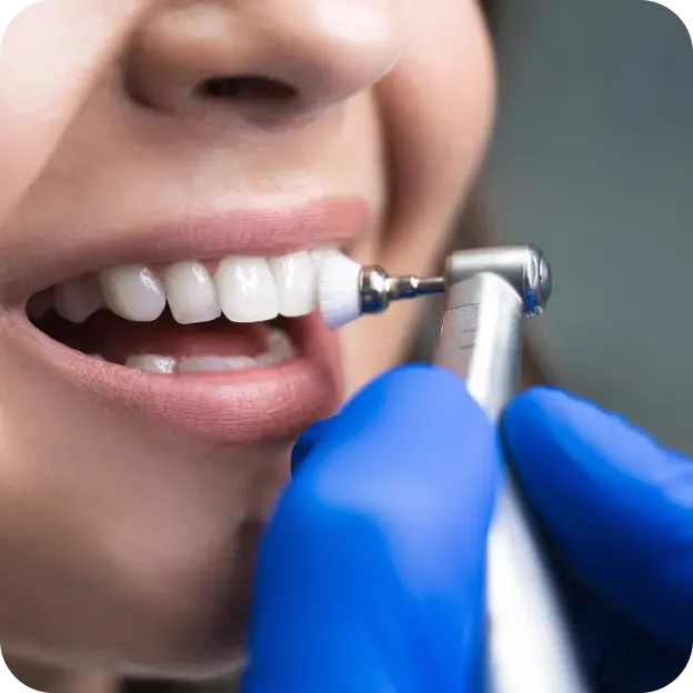 Teeth Polishing